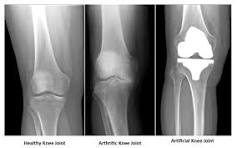  A total knee replacement .. pain with a smile